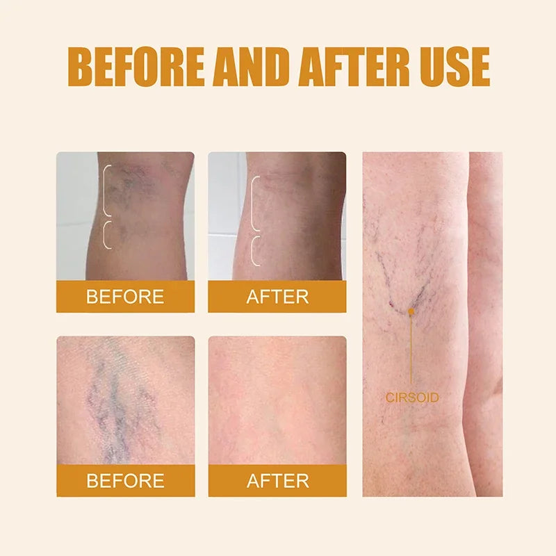 Laser Therapy Blue Light Pen